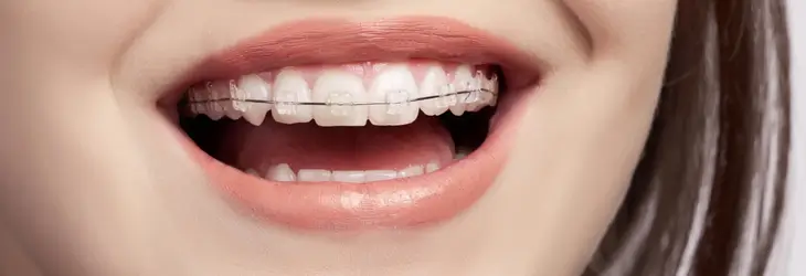 Traitement orthodontie